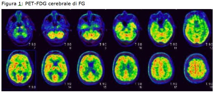 Figura 1: PET-FDG cerebrale di FG
